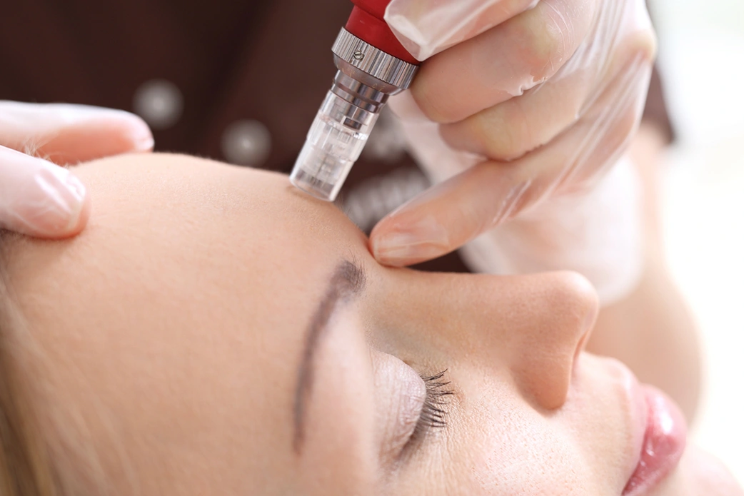 Micro Needling Radio Frequency